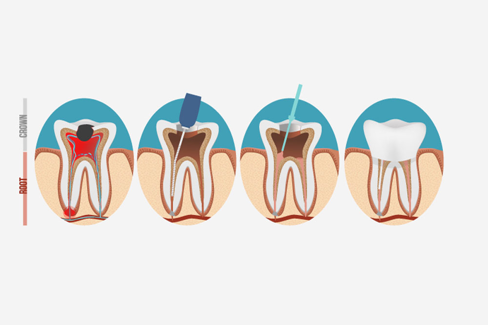 Root canal process