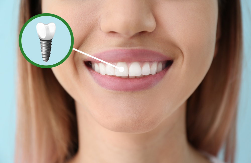 Young Woman With Dental Implant