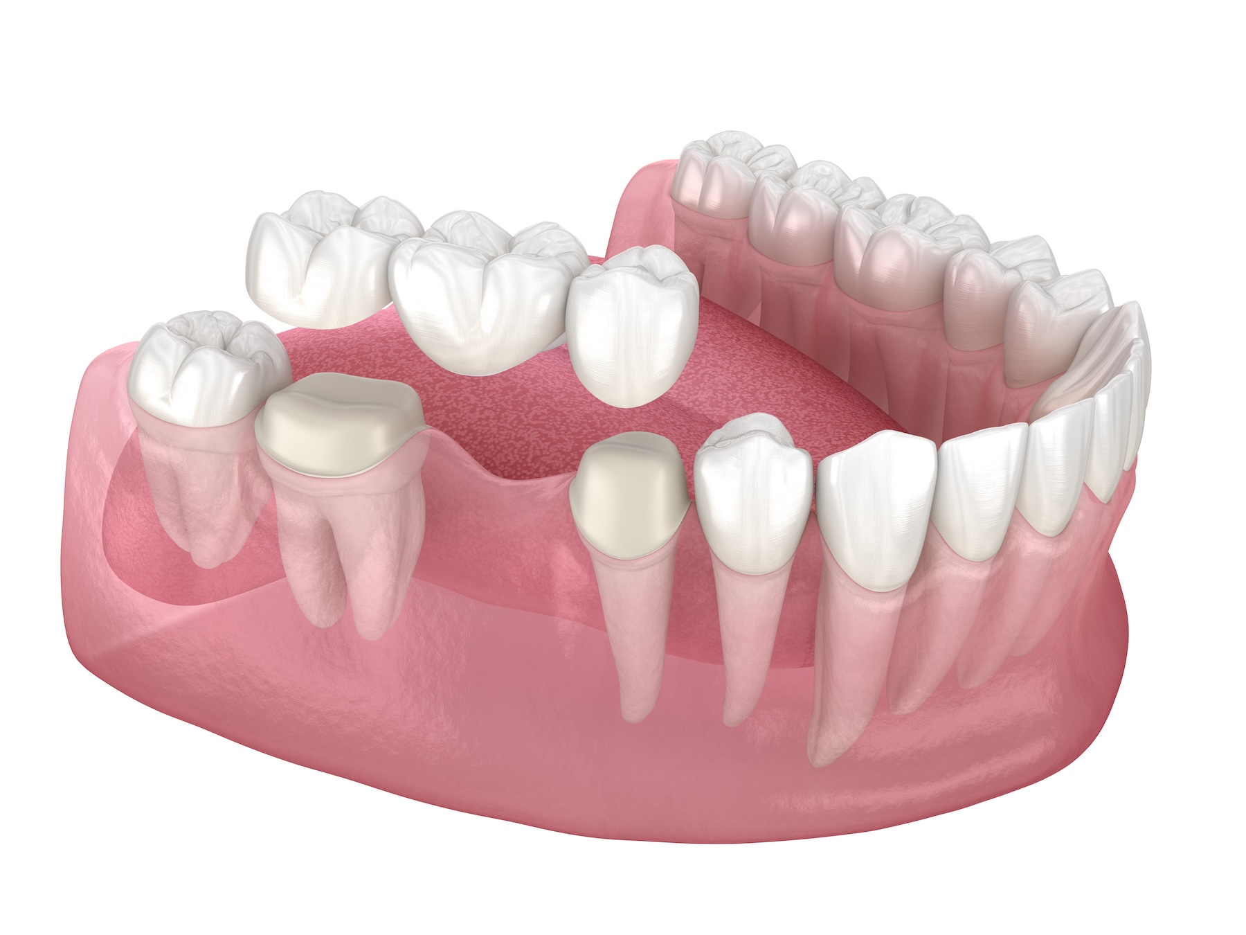 Dental bridge of 3 teeth over molar and premolar. Medically accurate 3D illustration of human teeth treatment