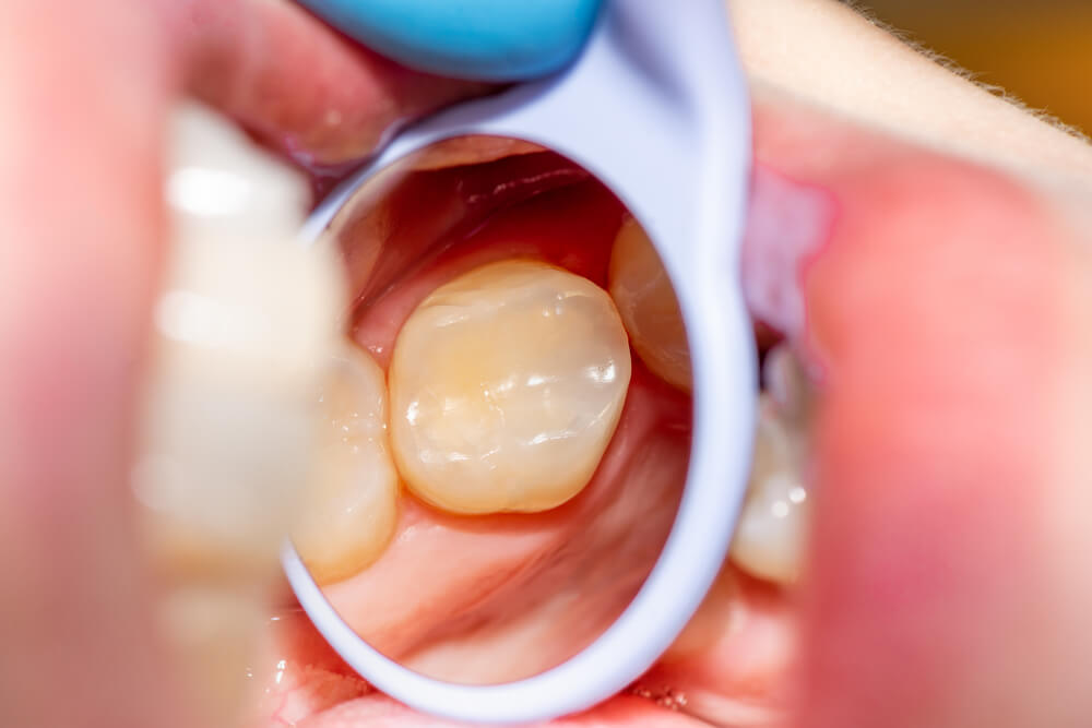 close-up treatment of a human tooth