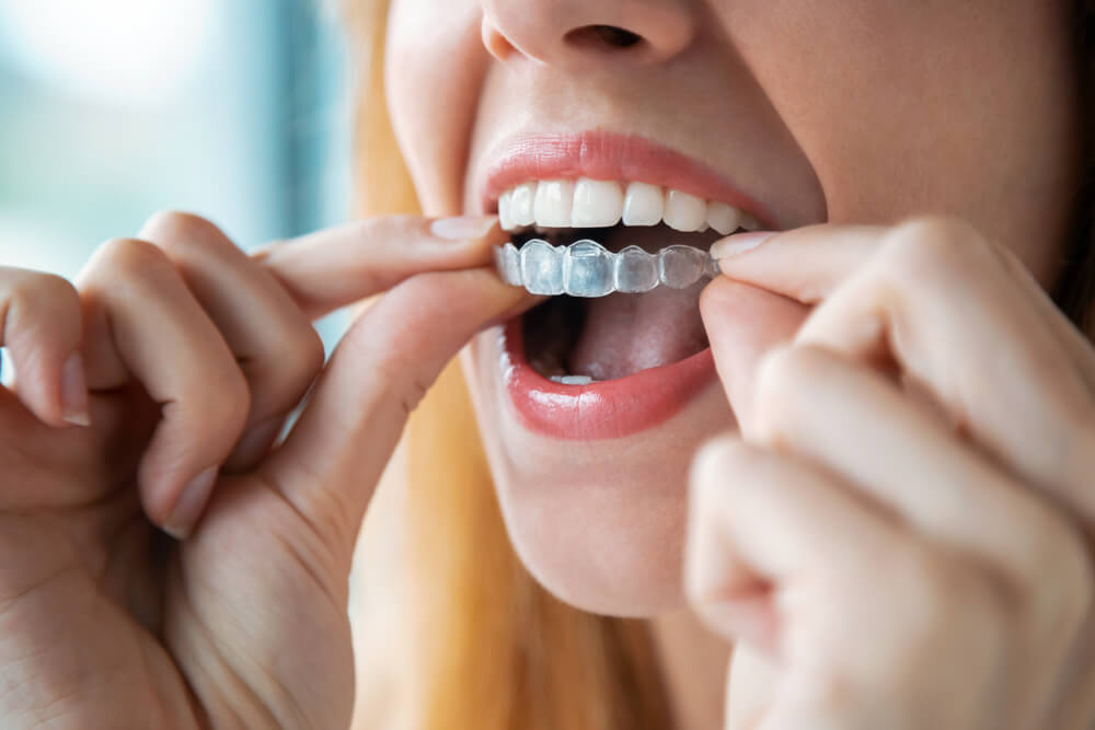 Close-up of woman wearing orthodontic silicone trainer